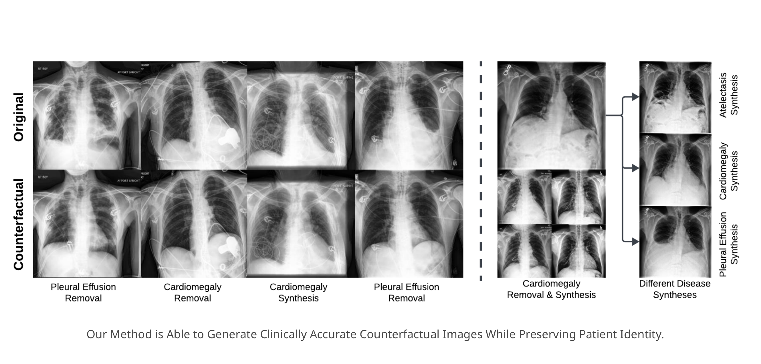 Counterfactual disease removal comparison